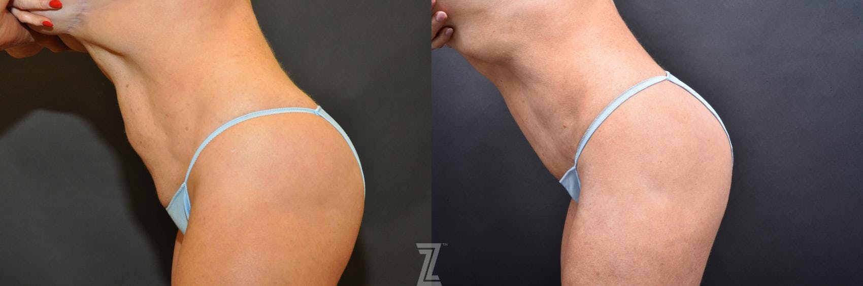 Skin Pinch Before & After Gallery - Patient 132886906 - Image 3