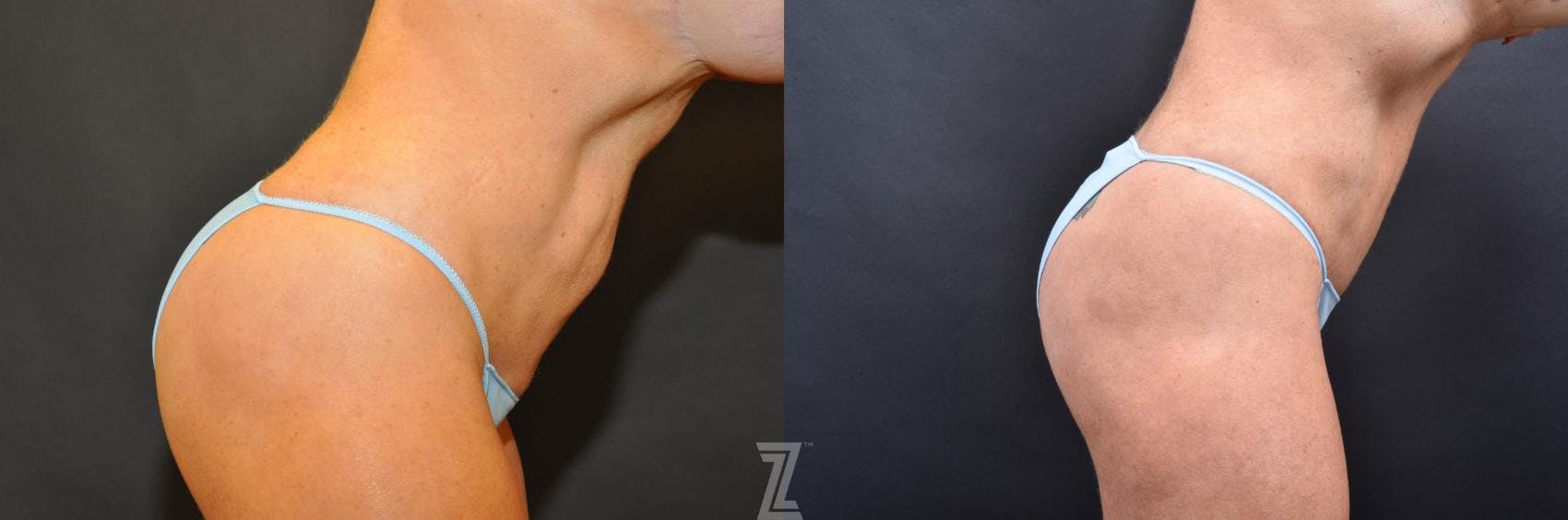 Skin Pinch Before & After Gallery - Patient 132886906 - Image 5