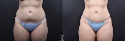 Austin Skin Pinch Before & After Gallery - Patient 132886936 - Image 1 - The Piazza Center