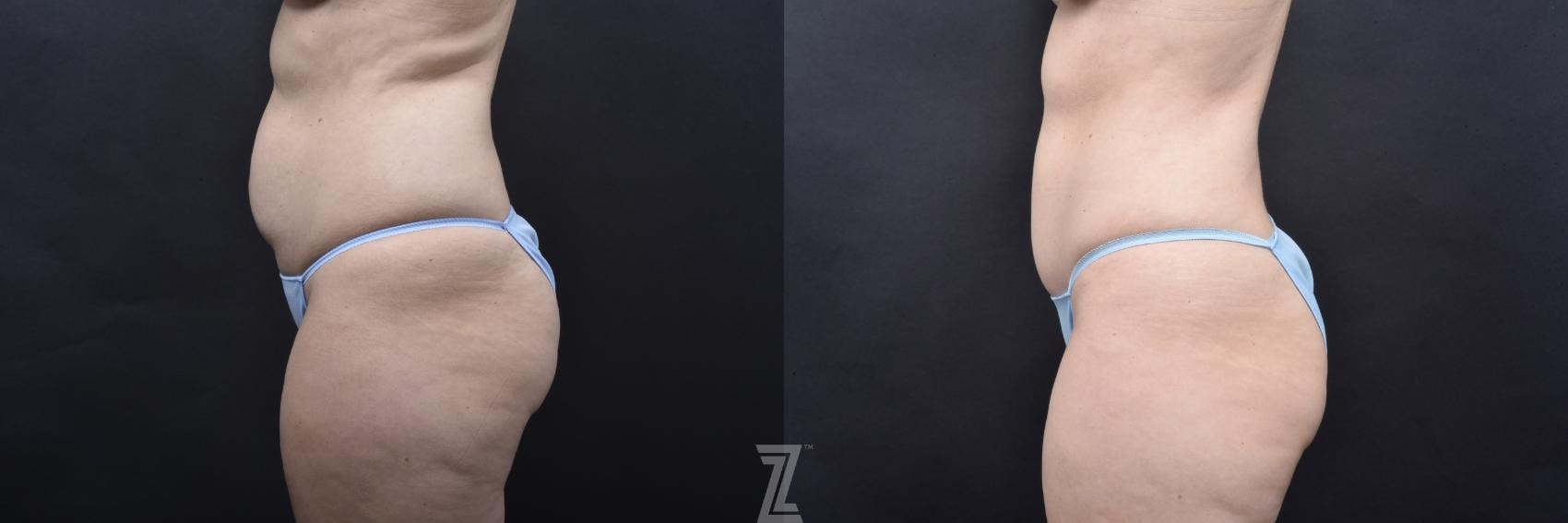 Skin Pinch Before & After Gallery - Patient 132886936 - Image 2