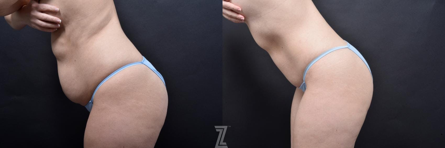 Skin Pinch Before & After Gallery - Patient 132886936 - Image 3