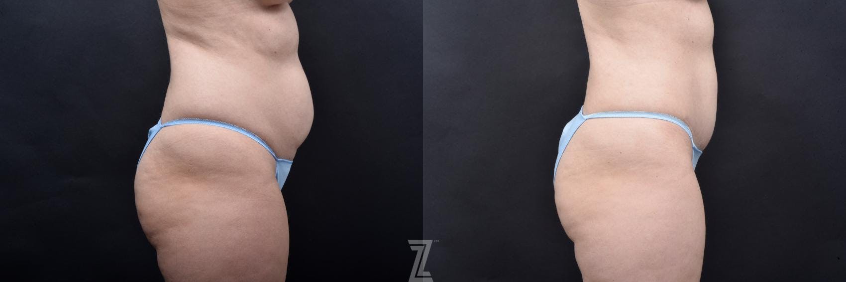 Skin Pinch Before & After Gallery - Patient 132886936 - Image 4