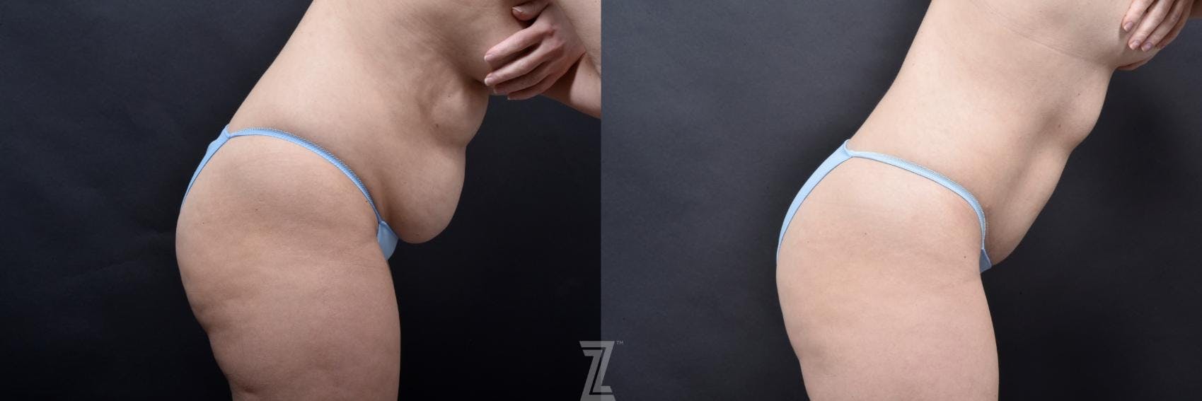 Skin Pinch Before & After Gallery - Patient 132886936 - Image 5