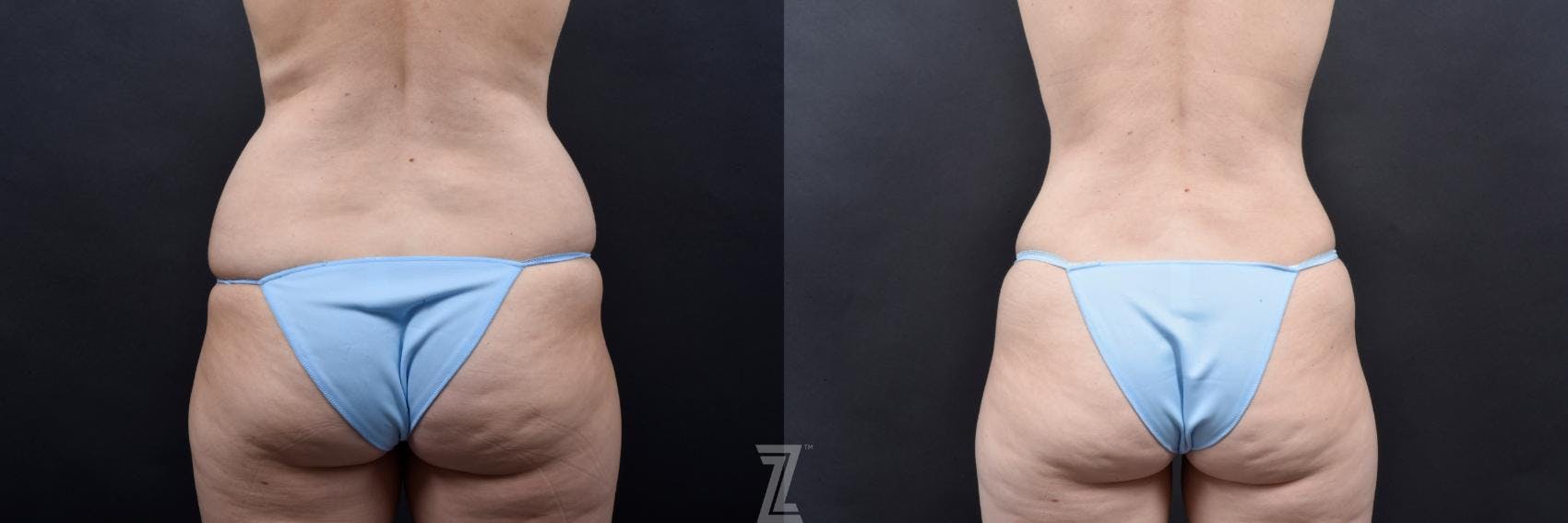 Skin Pinch Before & After Gallery - Patient 132886936 - Image 6