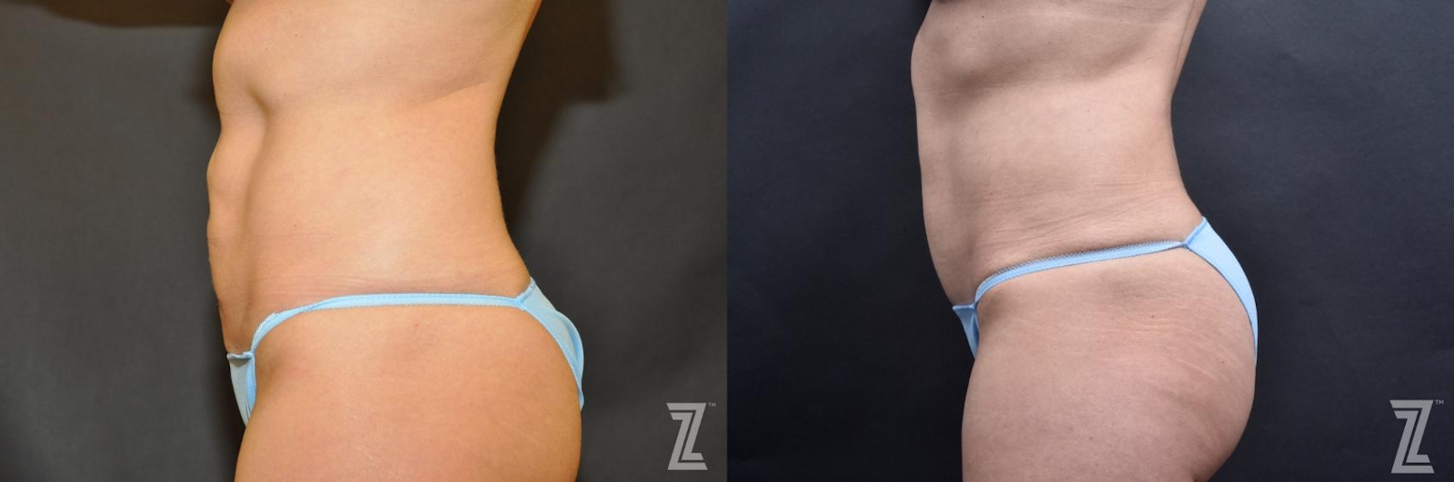Austin Skin Pinch Before & After Gallery - Patient 132886938 - Image 2 - The Piazza Center