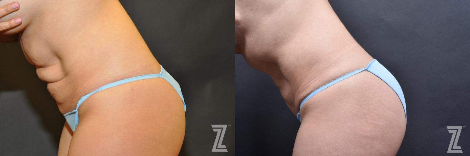 Austin Skin Pinch Before & After Gallery - Patient 132886938 - Image 3 - The Piazza Center