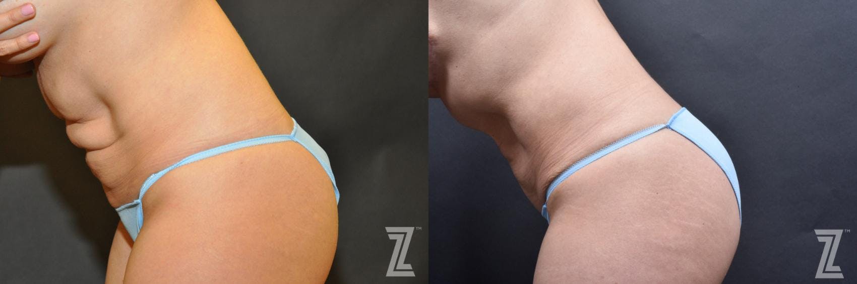 Skin Pinch Before & After Gallery - Patient 132886938 - Image 3