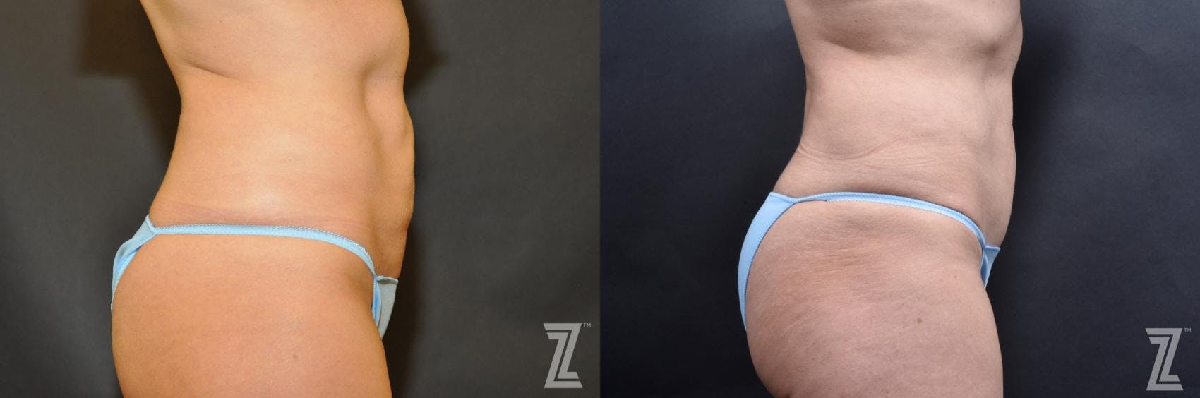 Skin Pinch Before & After Gallery - Patient 132886938 - Image 4