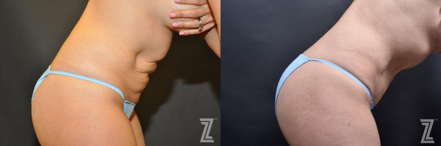 Skin Pinch Before & After Gallery - Patient 132886938 - Image 5