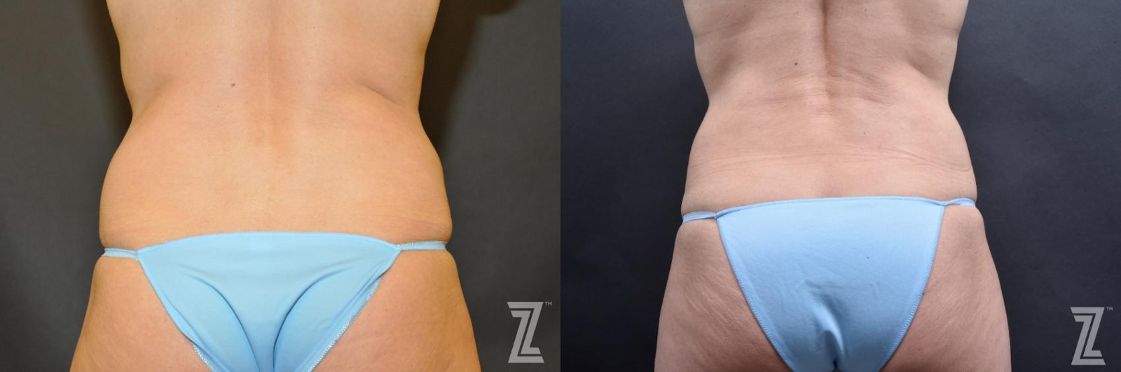 Austin Skin Pinch Before & After Gallery - Patient 132886938 - Image 6 - The Piazza Center