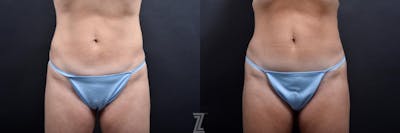 Austin Skin Pinch Before & After Gallery - Patient 132886939 - Image 1 - The Piazza Center