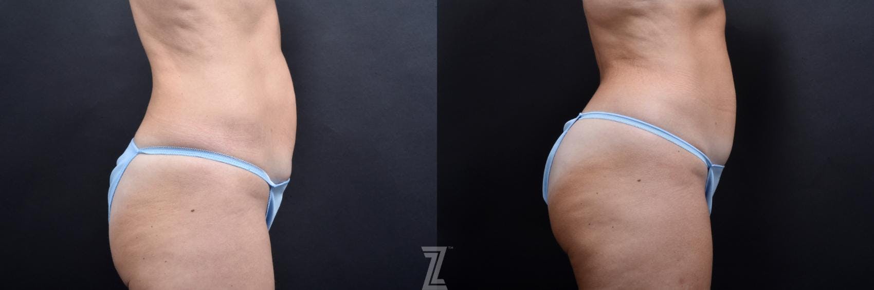 Skin Pinch Before & After Gallery - Patient 132886939 - Image 4