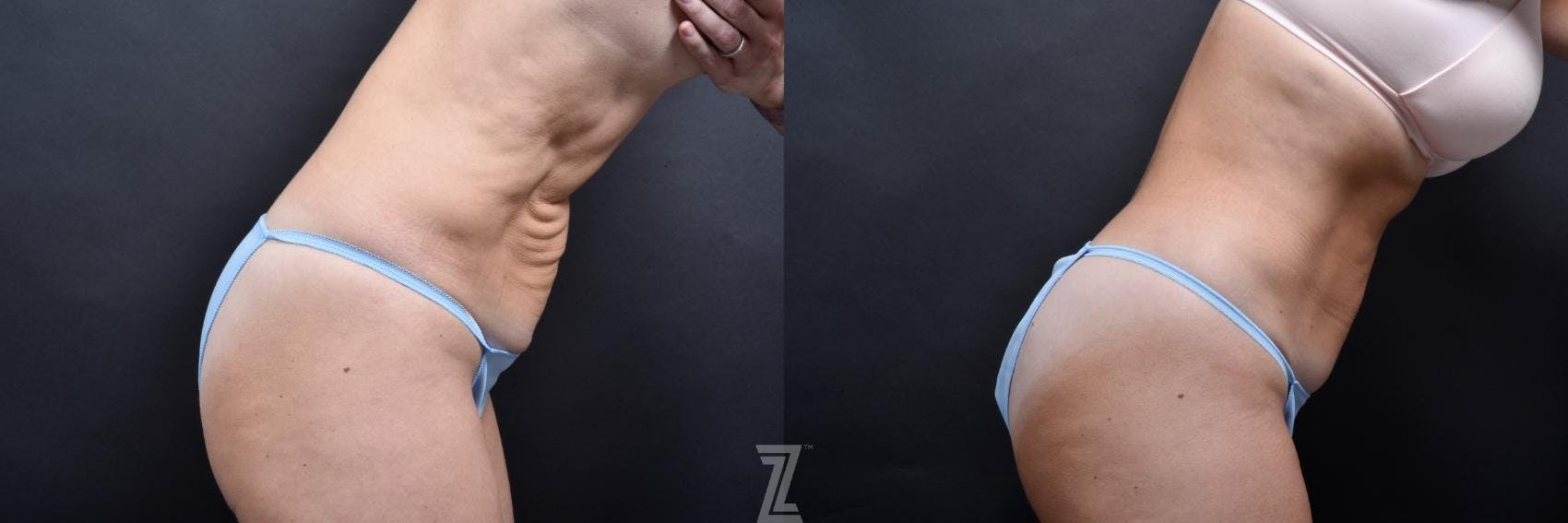Skin Pinch Before & After Gallery - Patient 132886939 - Image 5