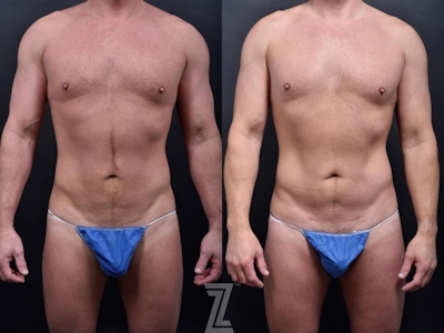 Liposuction Before & After Gallery - Patient 132886943 - Image 1