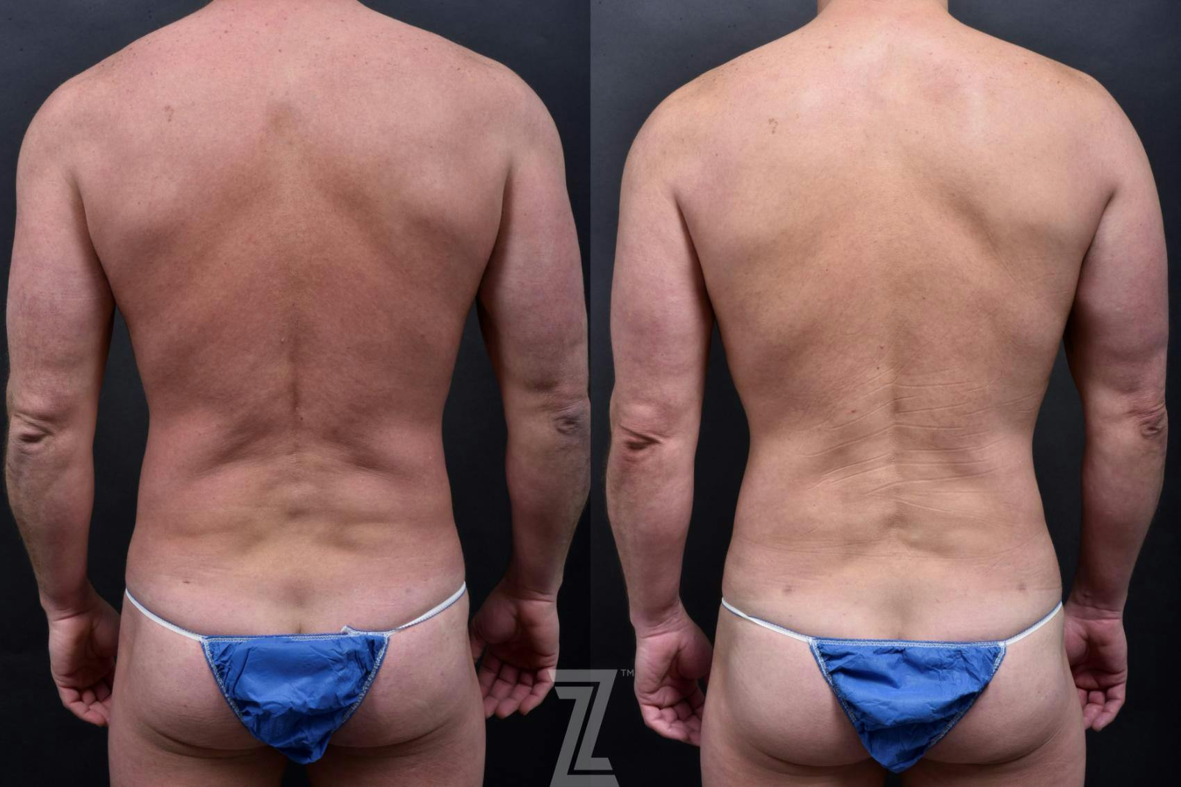 Liposuction Before & After Gallery - Patient 132886943 - Image 2