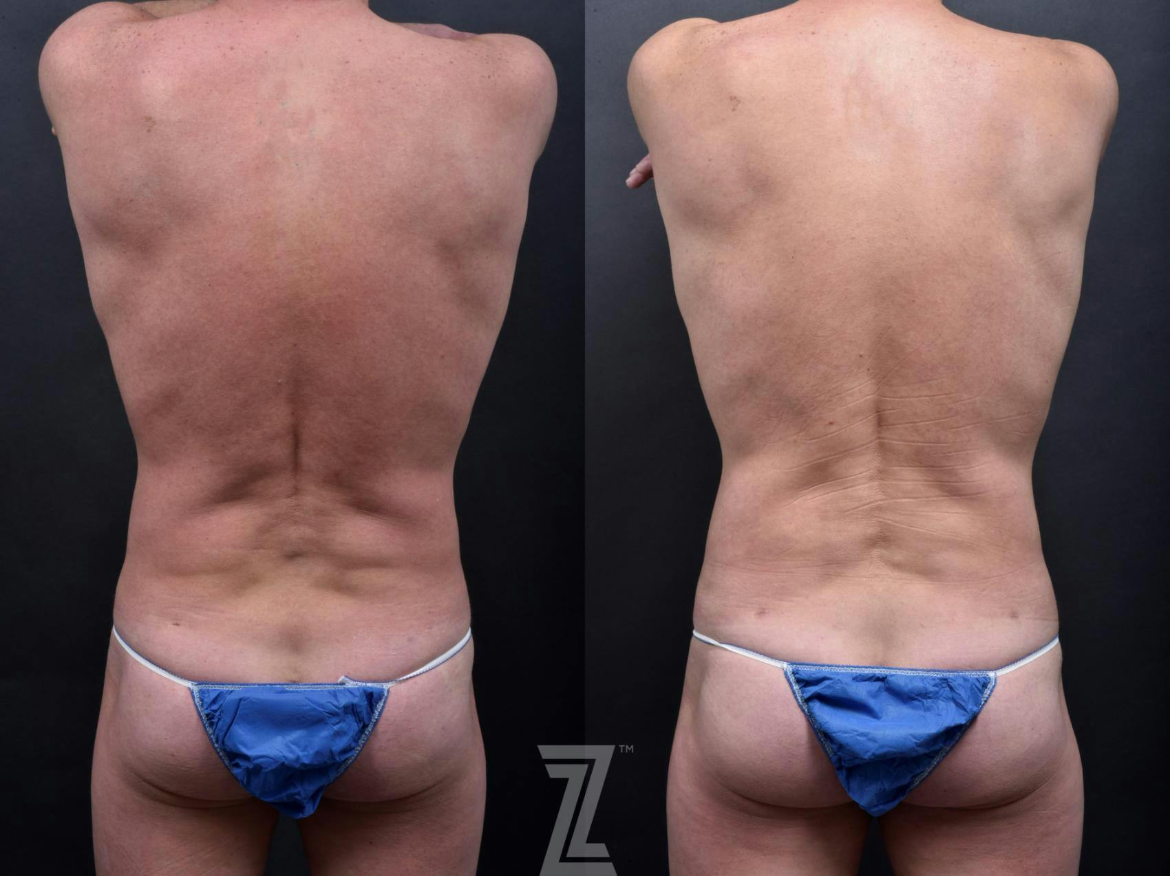 Liposuction Before & After Gallery - Patient 132886943 - Image 3