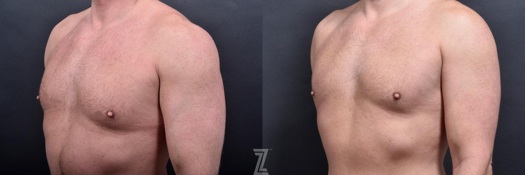 Liposuction Before & After Gallery - Patient 132886943 - Image 4