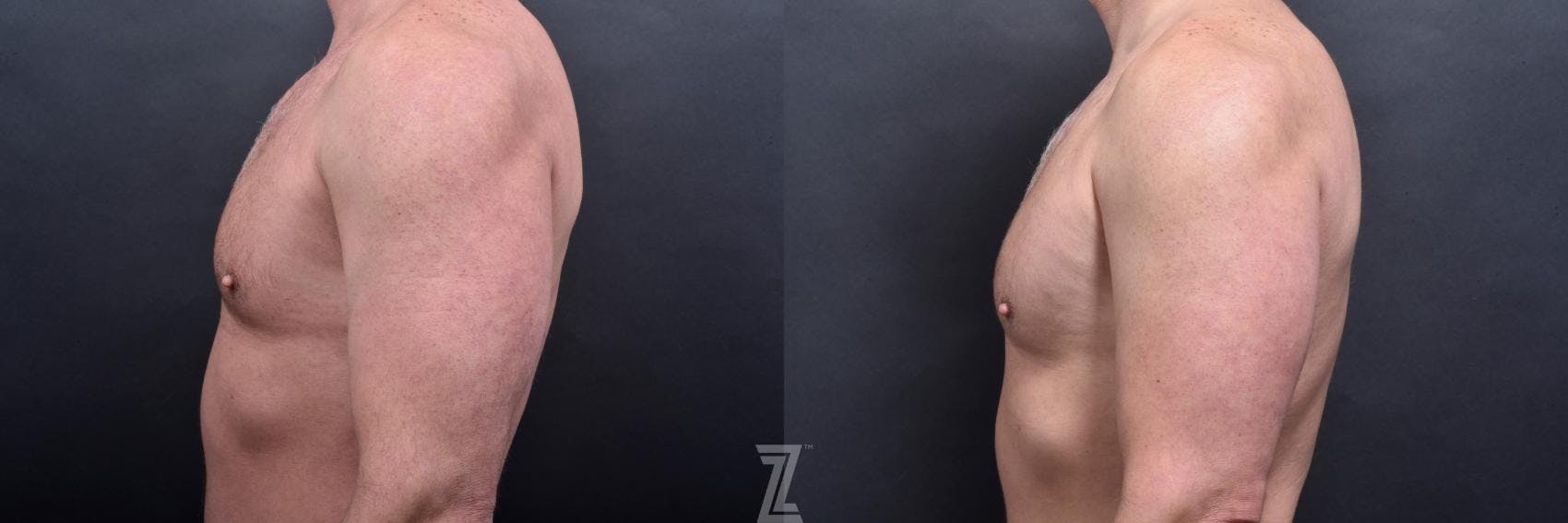 Liposuction Before & After Gallery - Patient 132886943 - Image 5