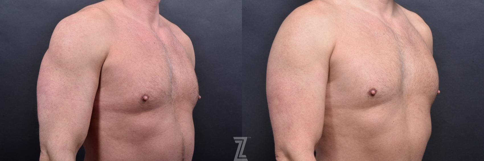 Liposuction Before & After Gallery - Patient 132886943 - Image 6