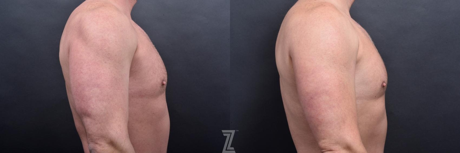Austin Liposuction Before & After Gallery - Patient 132886943 - Image 7 - The Piazza Center