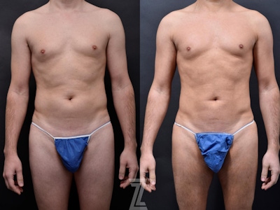 Liposuction Before & After Gallery - Patient 132886947 - Image 1