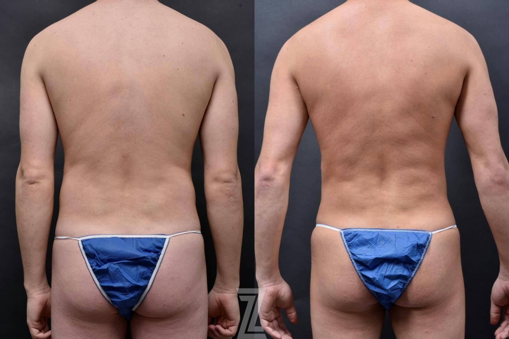Liposuction Before & After Gallery - Patient 132886947 - Image 2