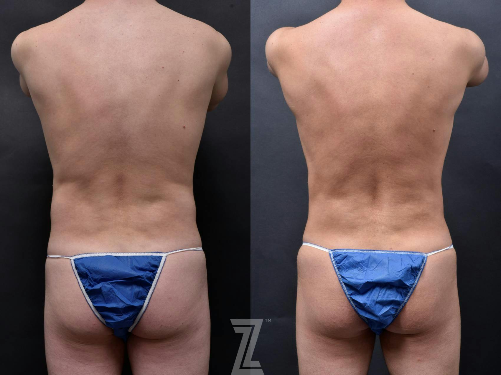 Liposuction Before & After Gallery - Patient 132886947 - Image 3