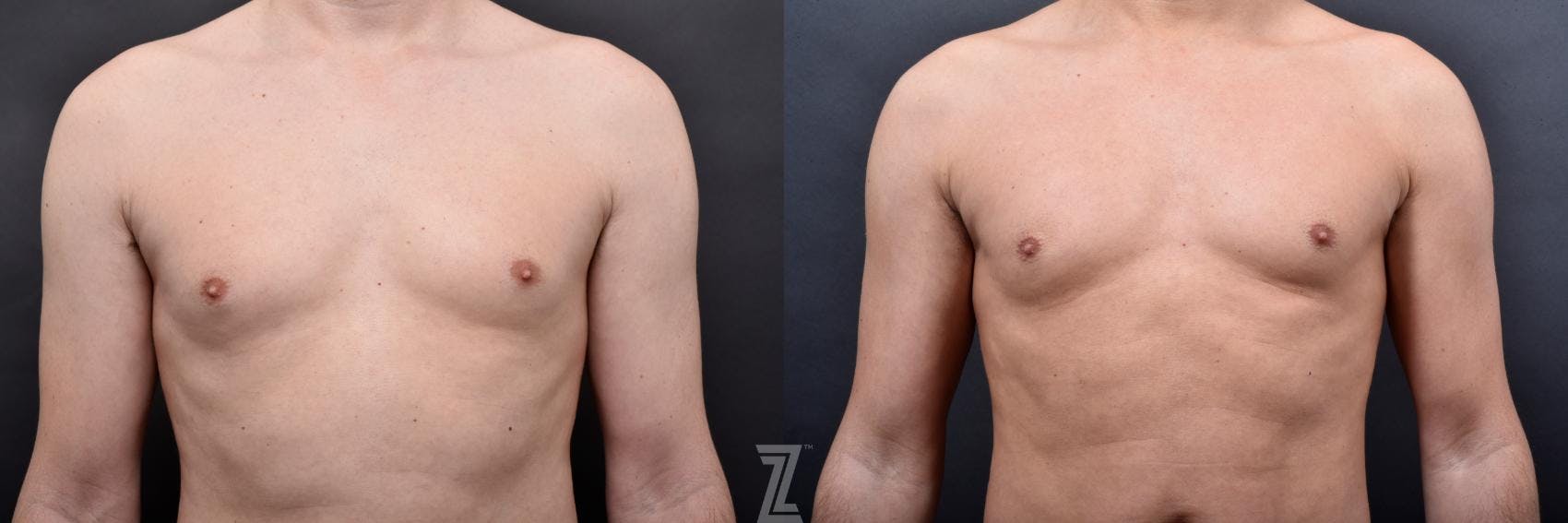 Liposuction Before & After Gallery - Patient 132886947 - Image 4