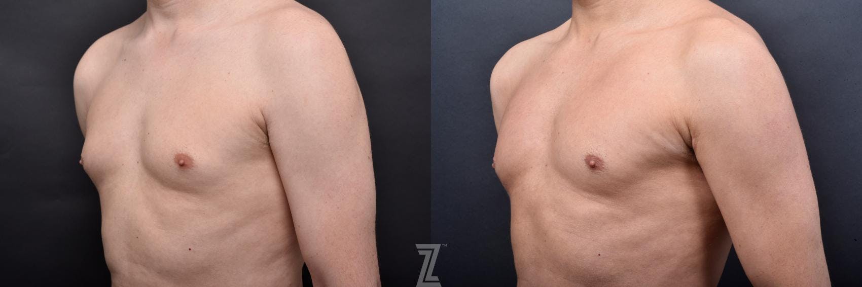 Liposuction Before & After Gallery - Patient 132886947 - Image 5