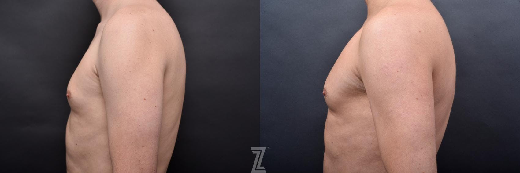 Liposuction Before & After Gallery - Patient 132886947 - Image 6