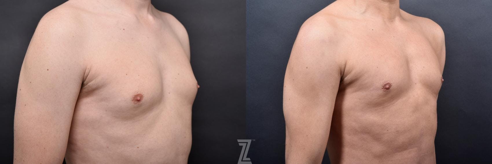 Liposuction Before & After Gallery - Patient 132886947 - Image 7