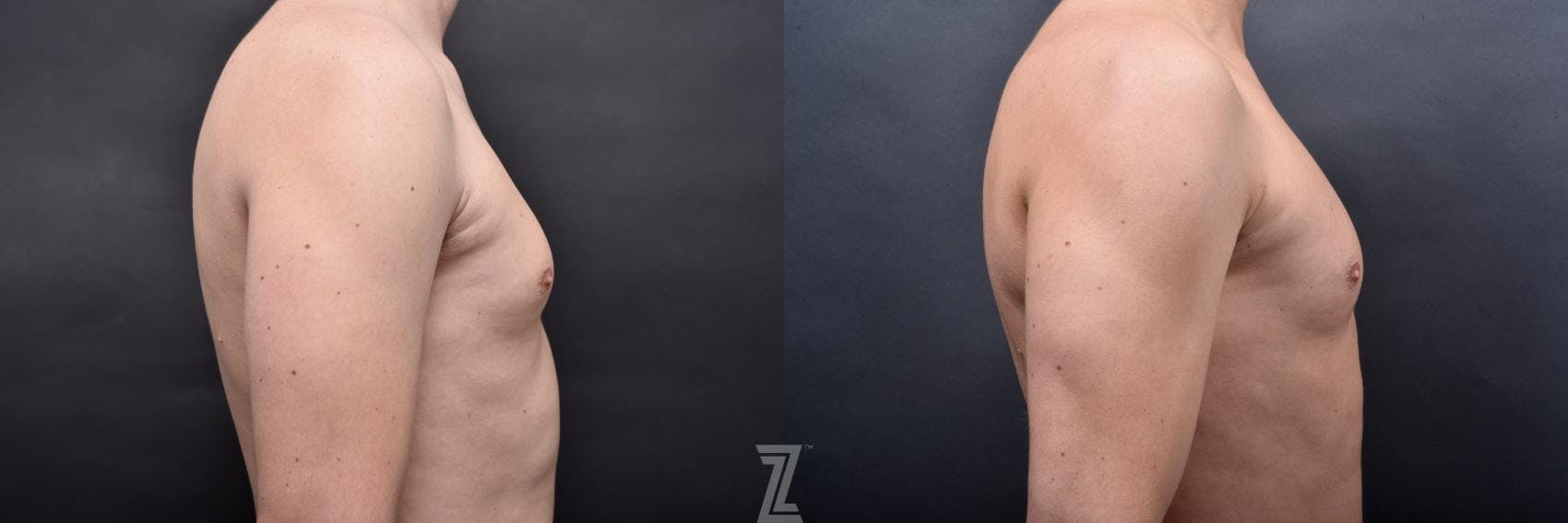 Liposuction Before & After Gallery - Patient 132886947 - Image 8