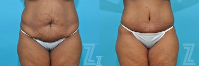 Liposuction Before & After Gallery - Patient 132887164 - Image 1