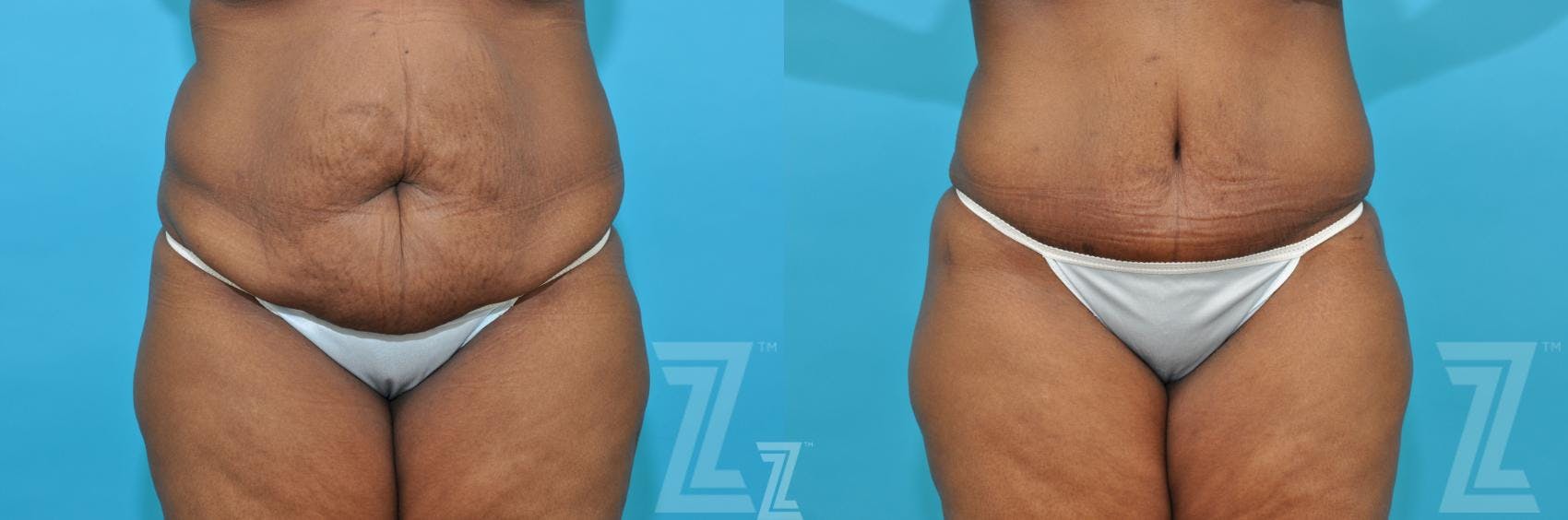 Tummy Tuck Before & After Gallery - Patient 117774 - Image 1
