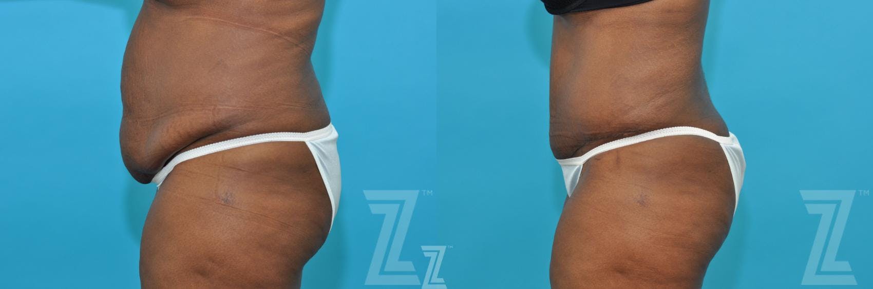 Tummy Tuck Before & After Gallery - Patient 117774 - Image 2