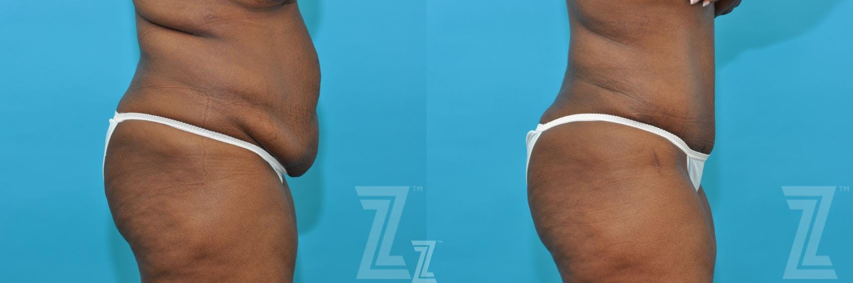 Tummy Tuck Before & After Gallery - Patient 117774 - Image 4