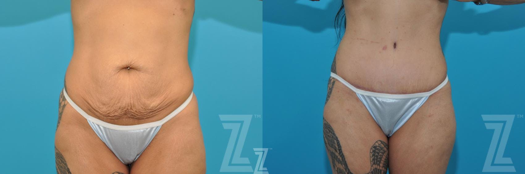 Liposuction Before & After Gallery - Patient 132887302 - Image 1