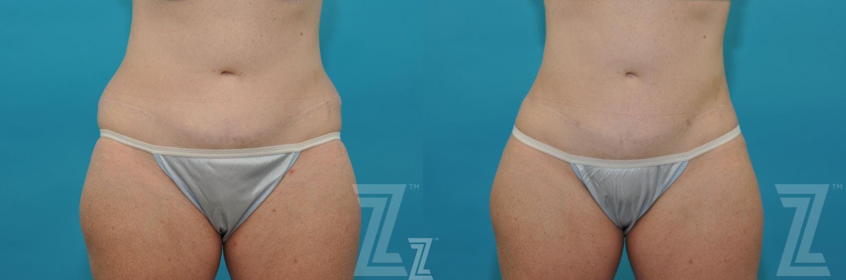 Liposuction Before & After Gallery - Patient 132887304 - Image 1