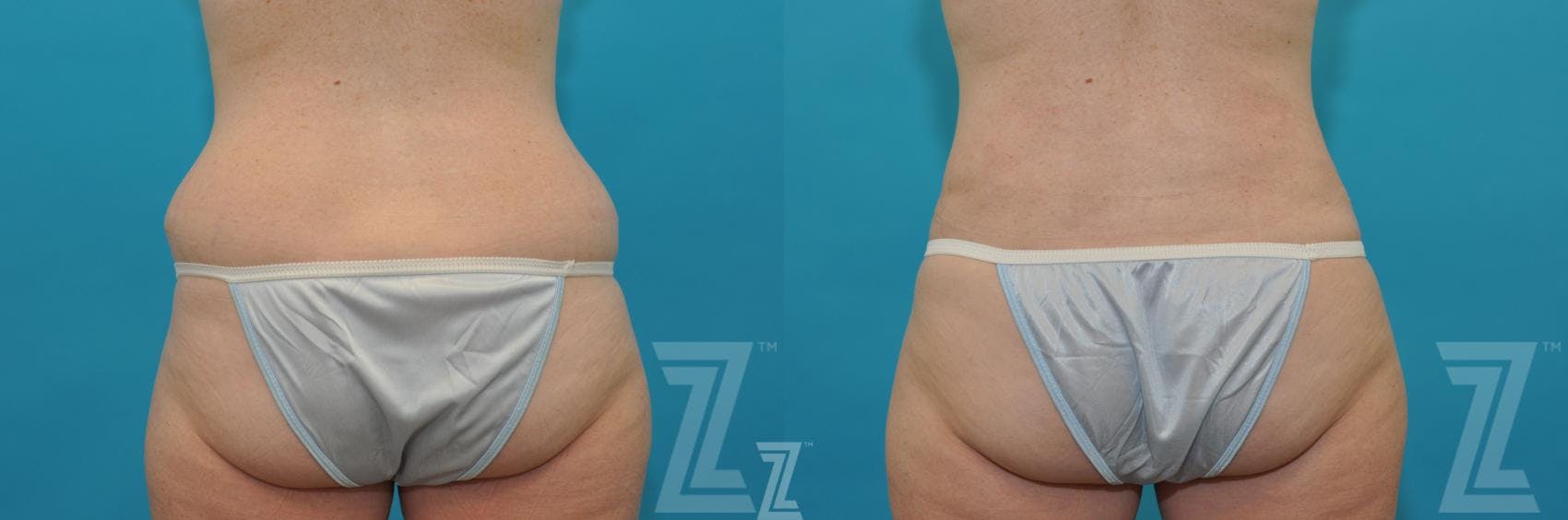 Liposuction Before & After Gallery - Patient 132887304 - Image 3
