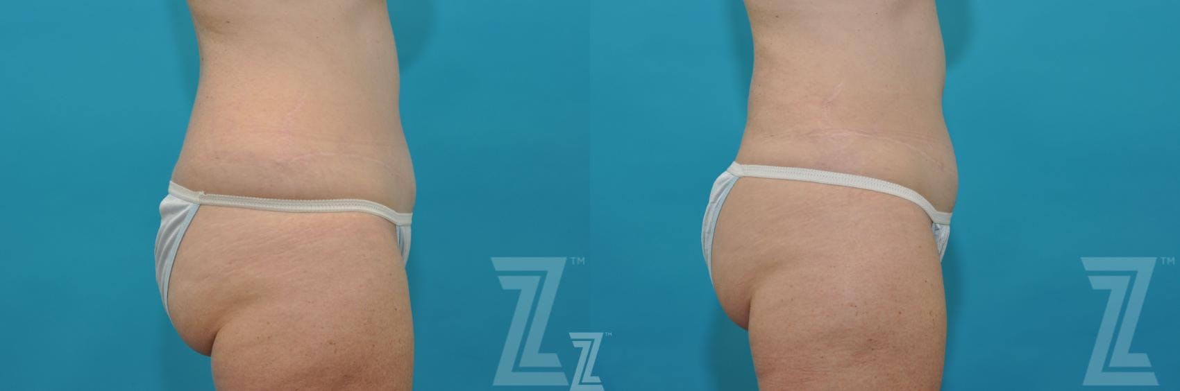 Liposuction Before & After Gallery - Patient 132887304 - Image 4