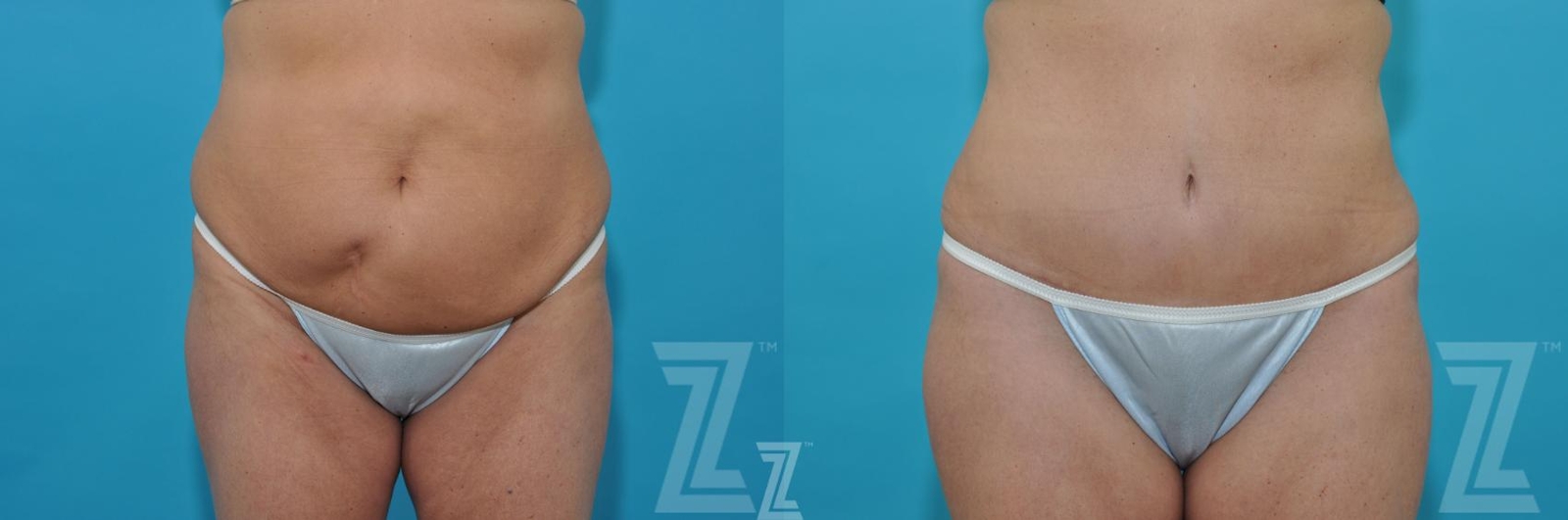 Austin Liposuction Before & After Gallery - Patient 132887306 - Image 1 - The Piazza Center
