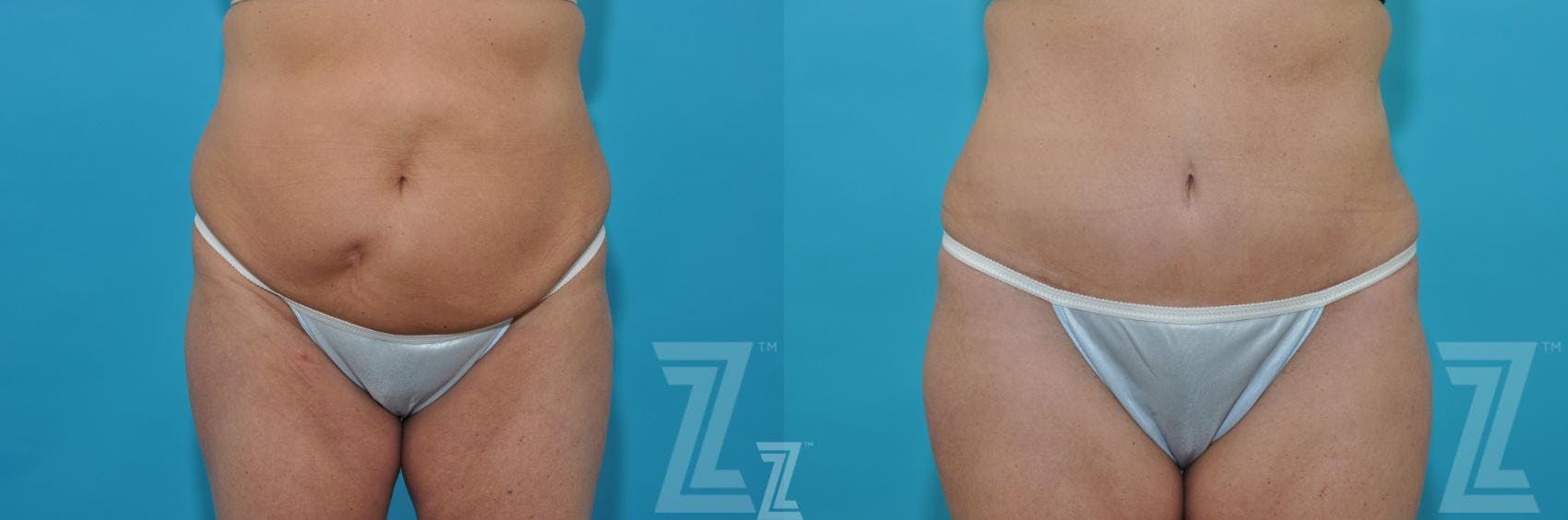 Liposuction Before & After Gallery - Patient 132887306 - Image 1