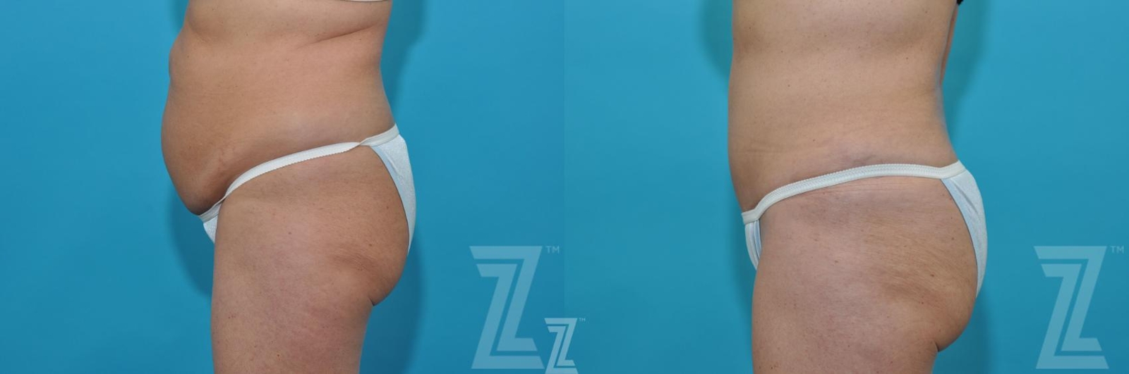 Austin Liposuction Before & After Gallery - Patient 132887306 - Image 2 - The Piazza Center