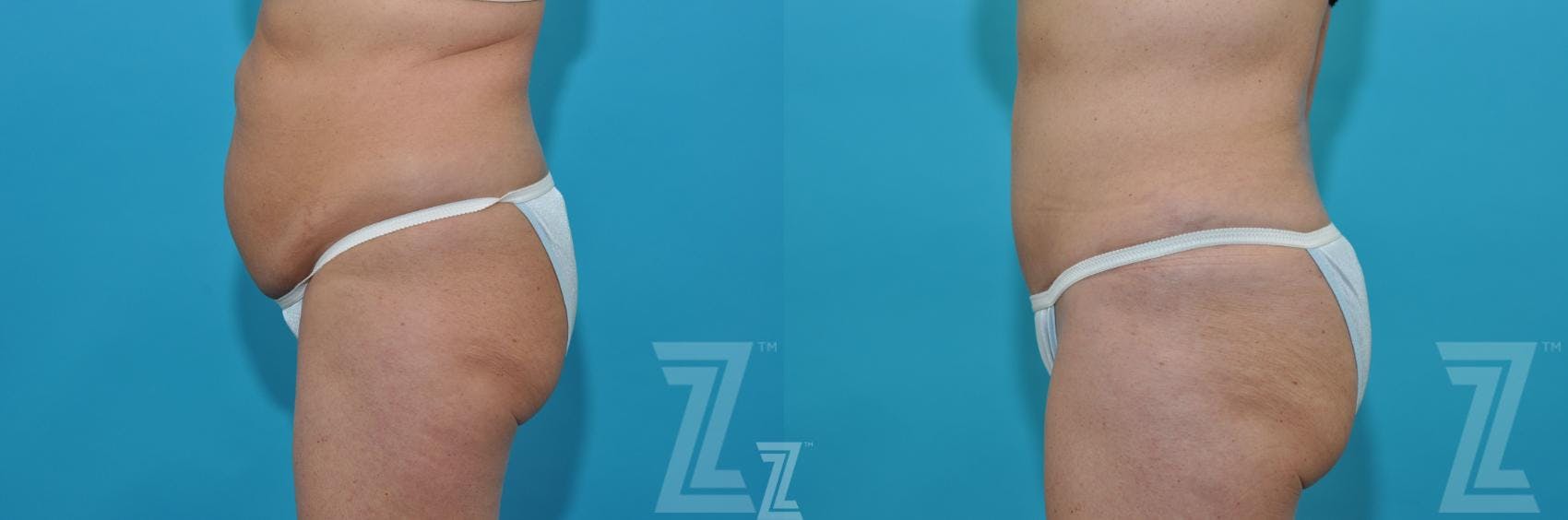 Liposuction Before & After Gallery - Patient 132887306 - Image 2