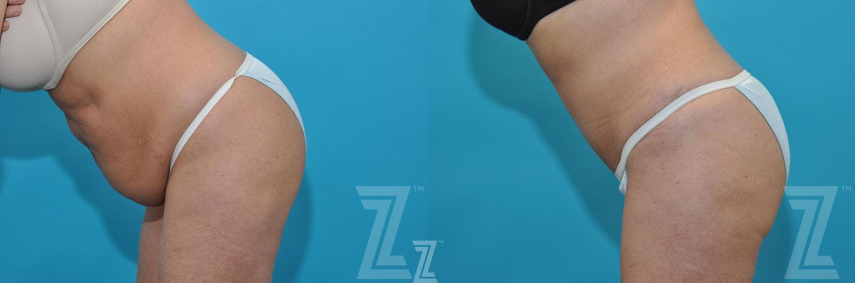Liposuction Before & After Gallery - Patient 132887306 - Image 3
