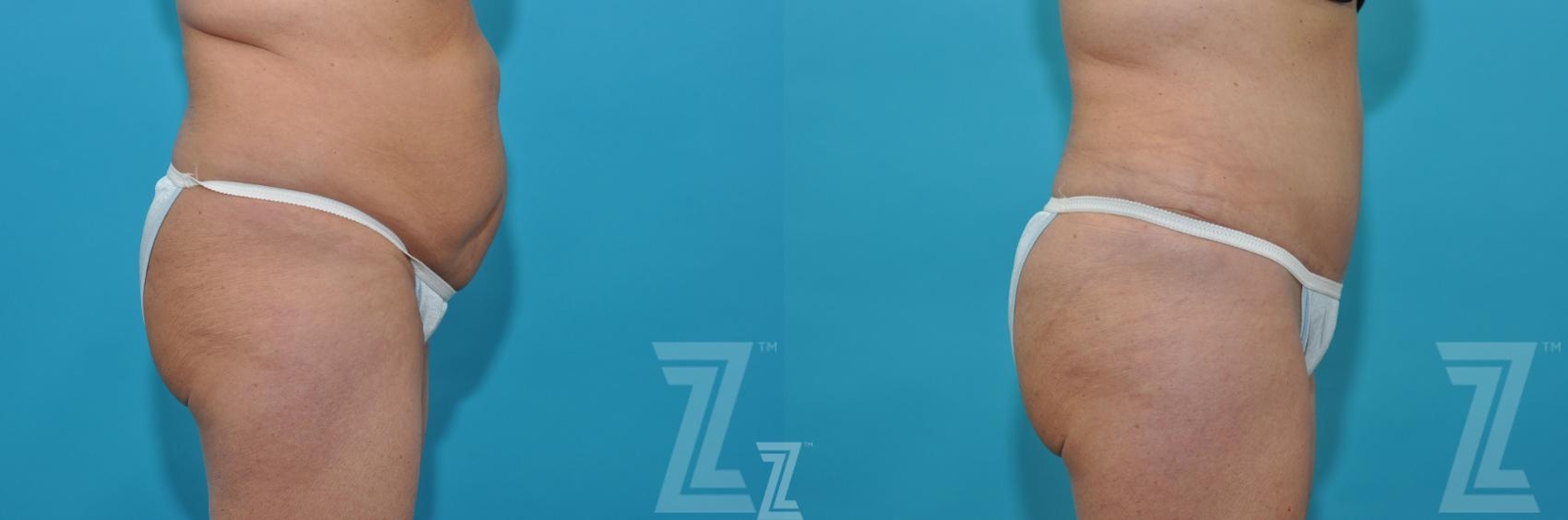 Austin Liposuction Before & After Gallery - Patient 132887306 - Image 4 - The Piazza Center