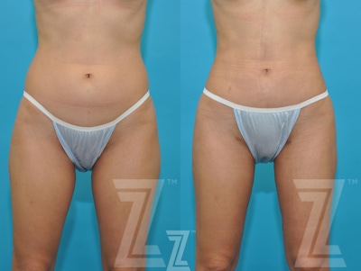 Liposuction Before & After Gallery - Patient 132893822 - Image 1