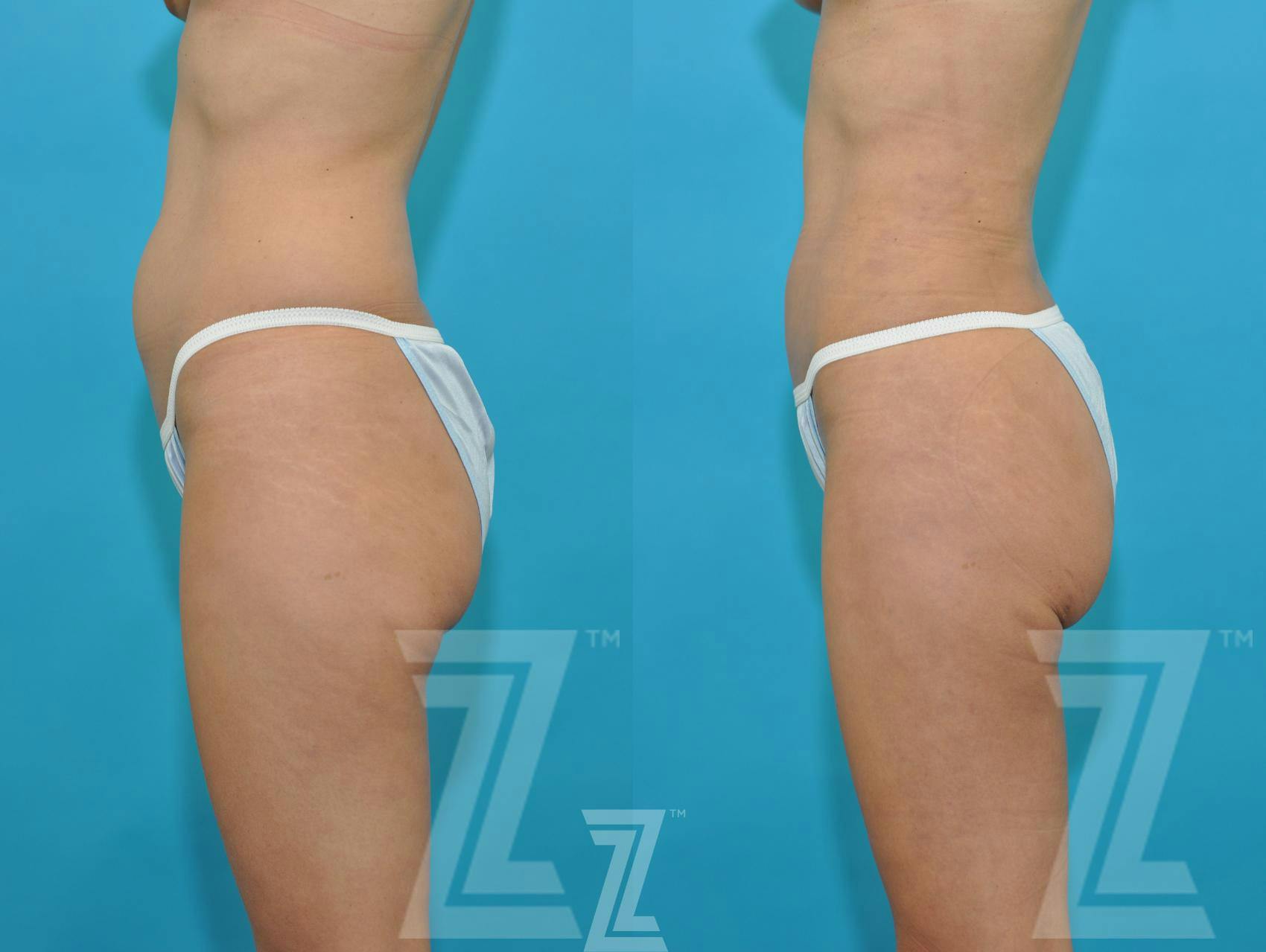 Liposuction Before & After Gallery - Patient 132893822 - Image 2