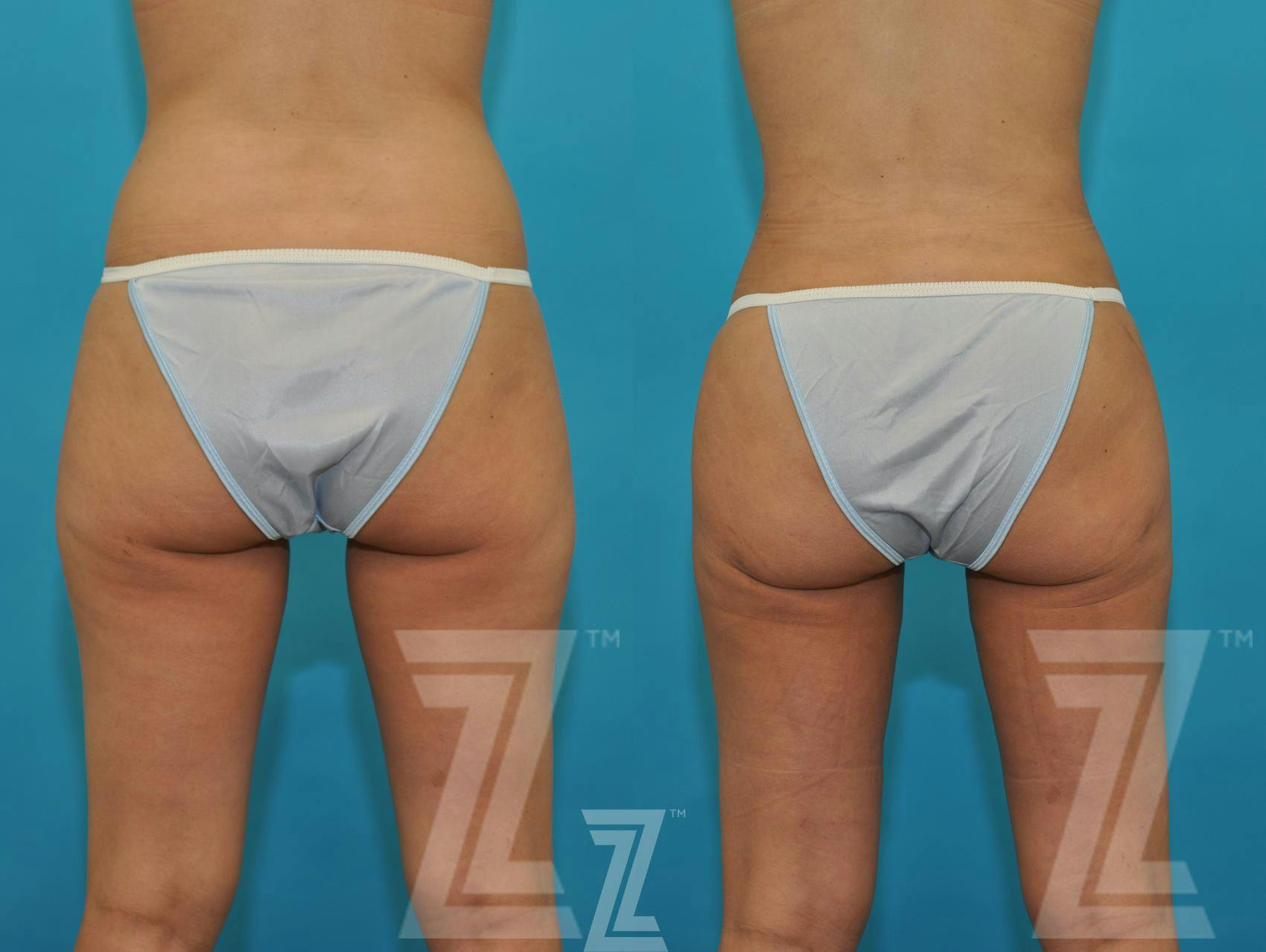 Liposuction Before & After Gallery - Patient 132893822 - Image 3