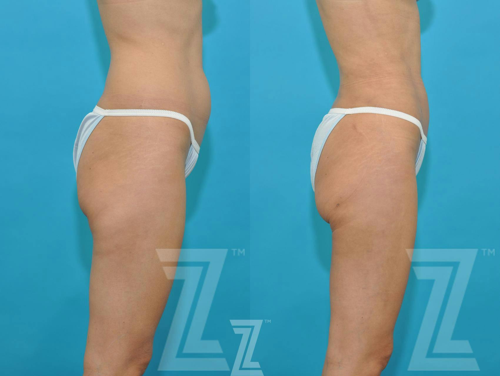 Liposuction Before & After Gallery - Patient 132893822 - Image 4